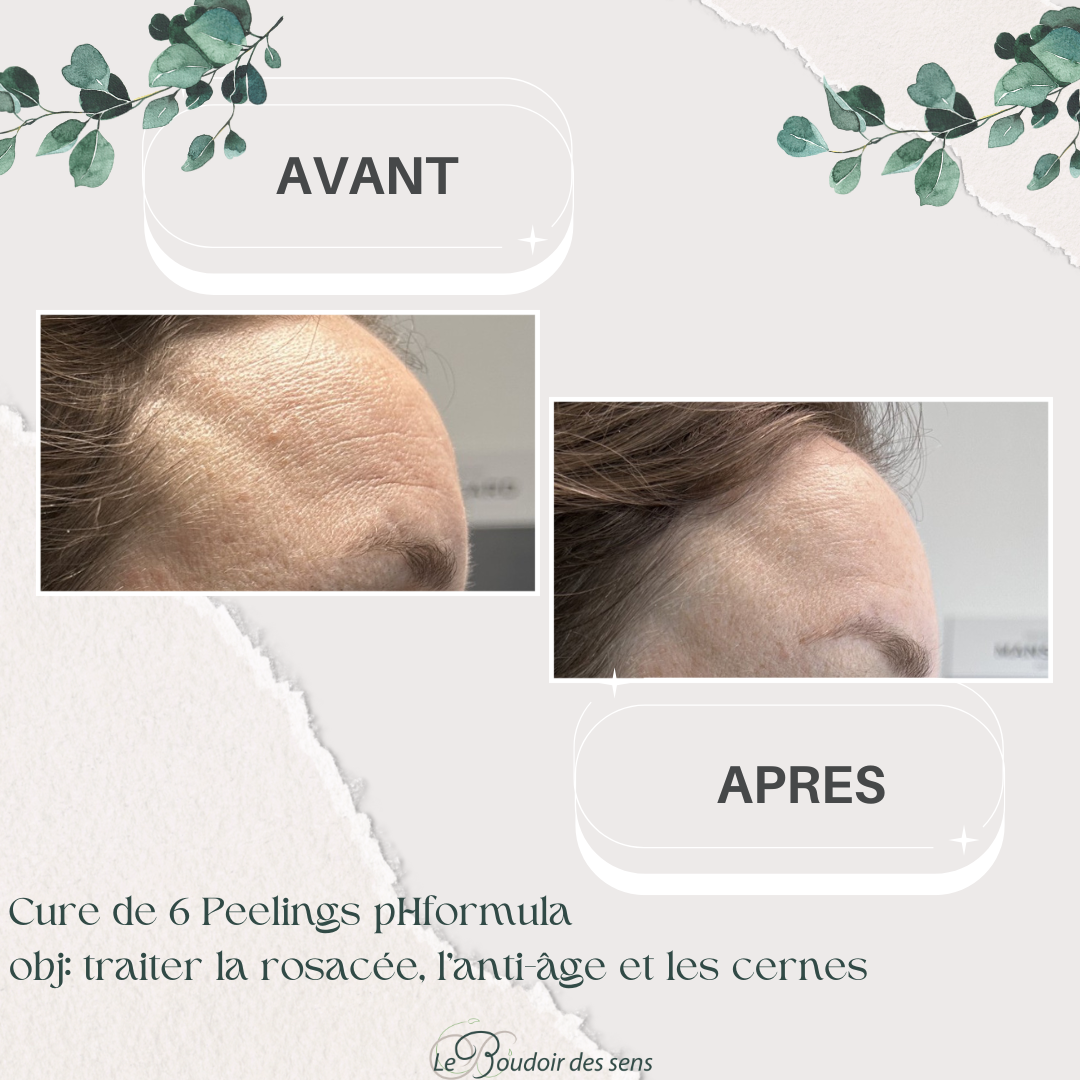 Avant Après cure de 6 Peelings
