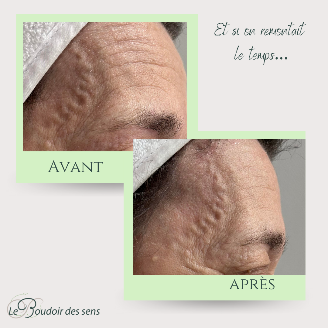 avant après bio visage