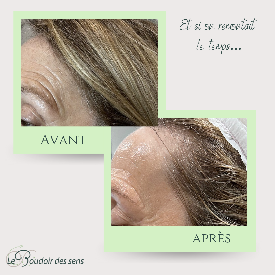 avant après cure de 6 néolift 1