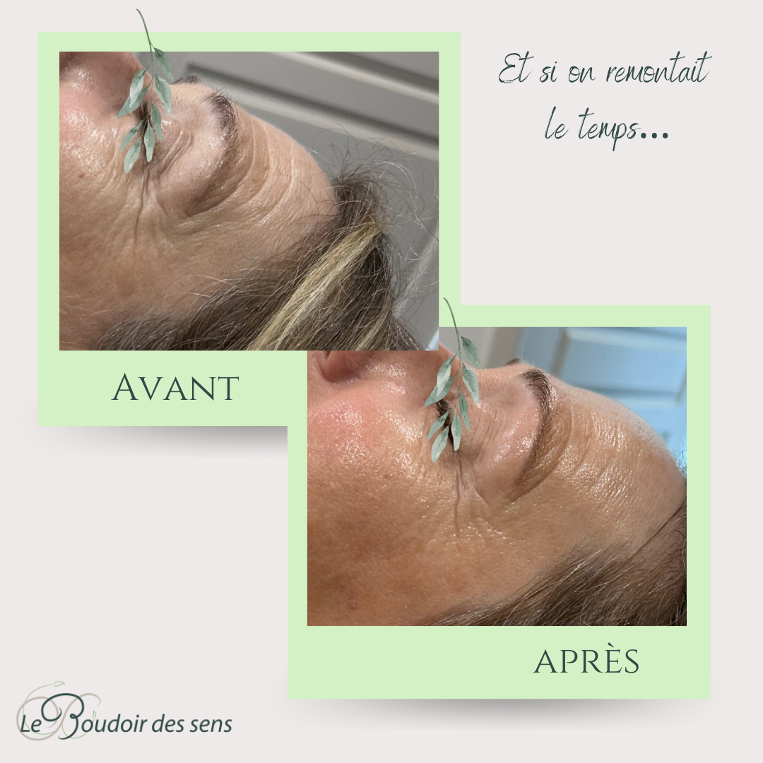 avant après cure de 6 néolift 2