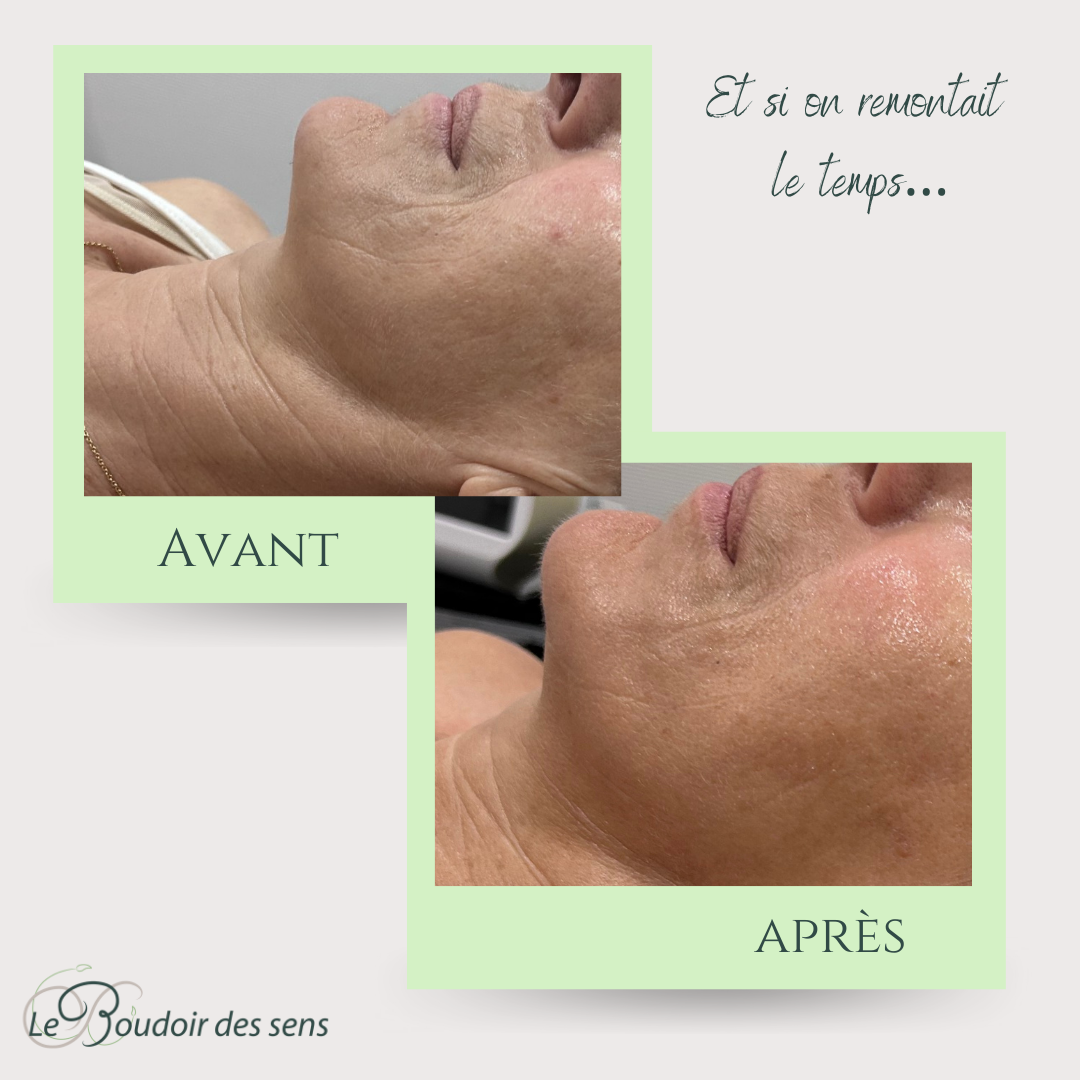 avant après cure de 6 néolift